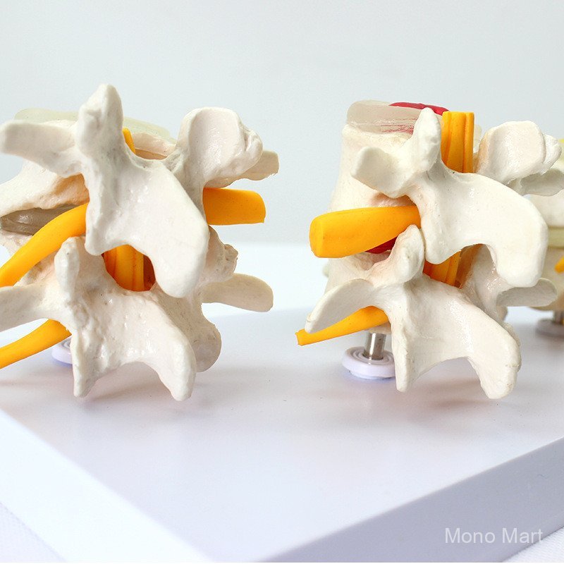 Human Lumbar Spine รุ่น Four-Stage Lumbar Spine Contrast Spine Disc Protruding Demonstration รุ่น Or