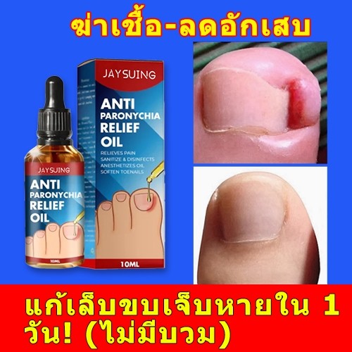 Jaysuing ปรับเล็บขบ น้ํายาปรับเล็บขบ โรคติดเชื้อที่ขอบเล็บ เล็บแตก ซ่อมแซมเล็บ รักษาเชื้อราที่เล็บ