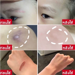 🌈ซื้อ 1 แถม 1 ✅ ผิวหนัง15ก ครีมลดตกขาว เป็นครีมลดรอยแผลเป็น เจลลบรอยแผลเป็น ครีมลดรอยสิว น้ําร้อนลวก ฯลฯ,