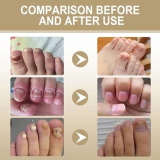 OUHOE เซรั่มบำรุงเล็บ Nail Serum 30ML เล็บเท้าคุด เอสเซนส์ซ่อมแซมเชื้อราที่เล็บ ทำให้เล็บนุ่ม เล็บหนาขึ้น เล็บเรี