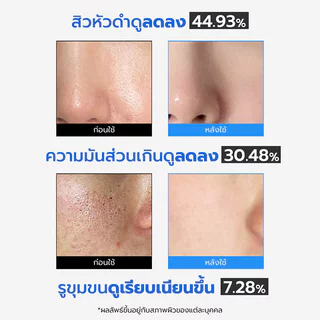 MEDICUBE Zero Pore Pad 2.0 155g [70 Pads] โทนเนอร์แพด 2 ด้าน เมดิคิวบ์ เผยผิวดูเรียบเนียน รูขุมขนดูกระชับ.