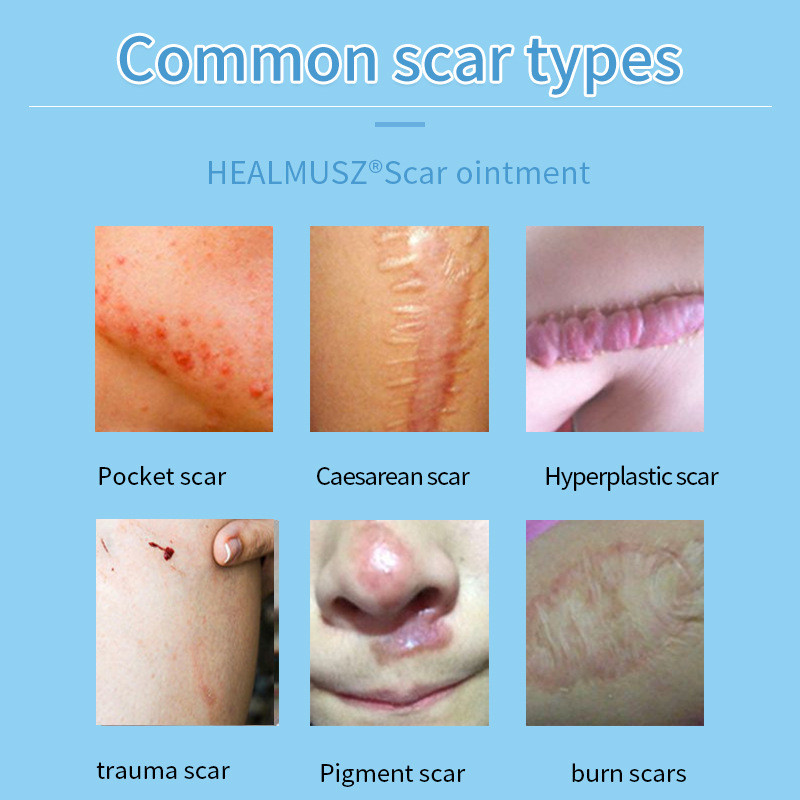 H HEALTMUSZ Scar Cream ลบหลังการผ่าตัด Scar Repair Genere Scar Source Self-Sale Repair