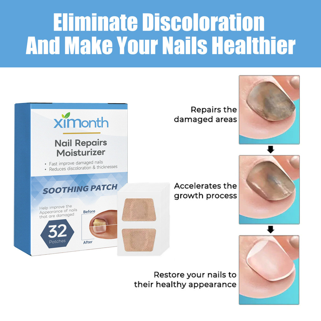 Ximonth Fungal แผ่นแปะรักษาเล็บสําหรับเล็บเท้าหนาคุดนุ่ม