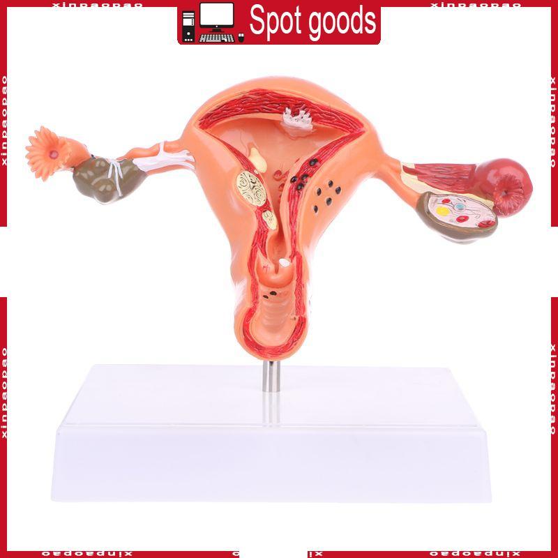 XI มดลูกทางพยาธิวิทยา Ovary Anatomical รุ่น Anatomy สําหรับเครื่องมือศึกษาส่วนข้าม