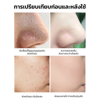 💕ราคาต่ำสุด💕เครื่องทำความสะอาดรูขุมขนไฟฟ้ารุ่นใหม่ เครื่องดูดสิว เครื่องดูดสิวเสี้ยน ปรับได้ 3ระดับกำจัดสิวหัวดำไฟฟ้า