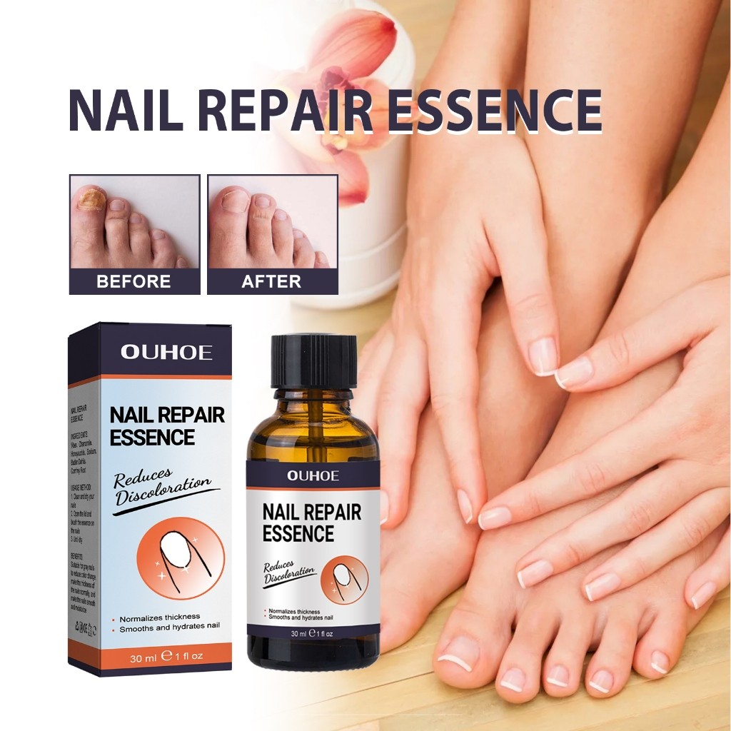 OUHOE เซรั่มเล็บ เชื้อราเล็บมือ Nail Care เซรั่มบำรุงเล็บ เซรั่มซ่อมแซมเล็บ และเล็บขบ บำรุงเล็บเสีย