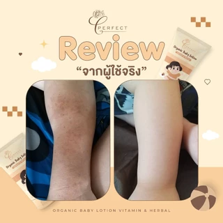 Perfect โลชั่นเด็ก สูตรออร์แกนิค บำรุงผิวขาว กระจ่างใส แก้ปัญหาขาลาย กู้ผิวคล้ำเสีย ลดรอยยุงกัด