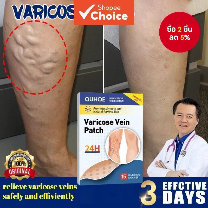 แผ่นแปะรักษาเส้นเลือดขอด Varecose Vein Remover ช่วยส่งเสริมการไหลเวียนโลหิต - 28793503672