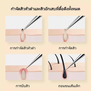 แหนบดึงสิวหัวดำคมกริบ / แหนบดึงสิวหัวดำสำหรับมืออาชีพ อุปกรณ์รักษาสิว