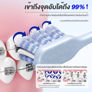 แปรงสีฟันจัดฟัน รูปตัว W แปรงจัดฟัน สำหรับคนจัดฟัน หัวเล็ก ขนนุ่ม ทำความสะอาดซอกฟันได้ดี อ่อนโยนต่อช่องปาก