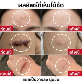 [รับประกันของแท้] Dermatix Ultra Gel 15g Advanced Formula Fade Old & New Scars | สูตรขั้นสูงช่วยลดเลือนรอยแผลเป็นทั้งเก่าและใหม่
