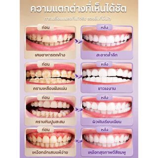 【ซ่อมหลุมผุเก่าได้】ซ่อมแซมฟัน/อุดฟัน/ฟื้นฟูฟัน/หลายฟังก์ชันในหนึ่ง/ครบจบในหลอดเดียว/หลากหลายในหนึ่งเดียว/หลุมผุเก่า/รอยผุเก่า/ฟันผุเรื้อรัง/ทำให้ฟันขาว/ป้องกันฟันผุ/ลดกลิ่นปาก