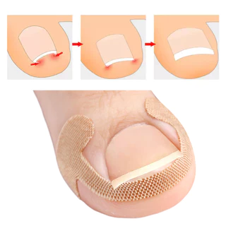 20/100 ชิ้น Professional คุด Toenail Correction สติกเกอร์ - Foot Corrector Anti Infection Nail Treatment Patch Toe Care