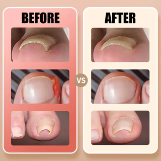 20/100 ชิ้น Professional คุด Toenail Correction สติกเกอร์ - Foot Corrector Anti Infection Nail Treatment Patch Toe Care