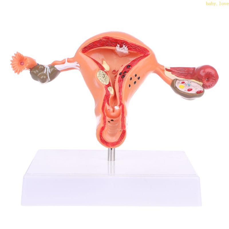 BLove* มดลูกทางพยาธิวิทยา Ovary Anatomical Model Anatomy สําหรับเครื่องมือศึกษาส่วนข้าม