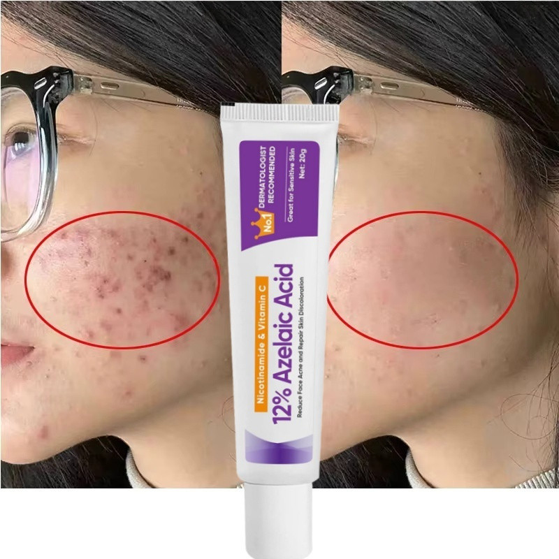 12% Azelaic Acid Cream Acne Treatment Pimple Scars Remover Repair Skin Redness การเปลี่ยนสี