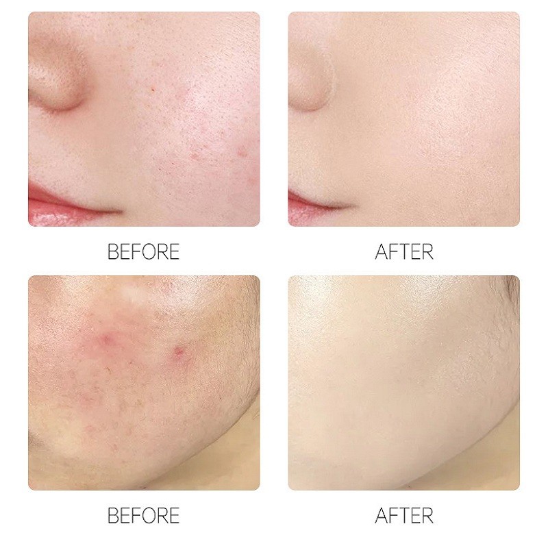 แผ่นแปะสิวที่มองไม่เห็น – สติ๊กเกอร์กําจัดสิวสําหรับซ่อมแซมสิวและการรักษารอยแผลเป็น - รูปที่ 4