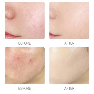 แผ่นแปะสิวที่มองไม่เห็น – สติ๊กเกอร์กําจัดสิวสําหรับซ่อมแซมสิวและการรักษารอยแผลเป็น