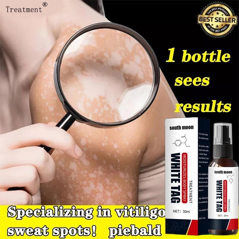 30ml {จัดส่งทันที} ครีมรักษา vitiligo ครีม vitiligo ครีม vitiligo น้ํายาล้าง กลายเป็นด่างขาว**-&