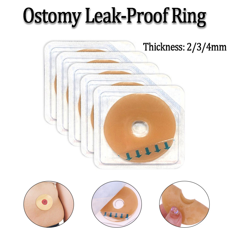 1PC Ostomy แหวนป้องกันการรั่วยืด Shaping Stoma แหวนป้องกันการรั่วไหลปกป้องผิว
