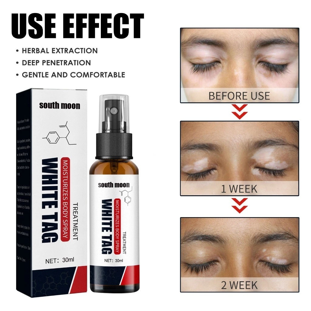 30ml {จัดส่งทันที} ครีมรักษา vitiligo ครีม vitiligo ครีม vitiligo น้ํายาล้าง กลายเป็นด่างขาว**-& - รูปที่ 2