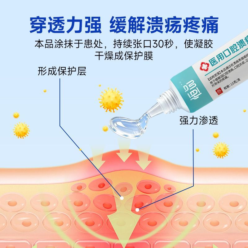 Hengpin Oral Ulcer Gel Medical Ulcer Oral Ulcer บรรเทา Fire บนลิ้นปากพิเศษสําหรับฟองอักเสบ20260624