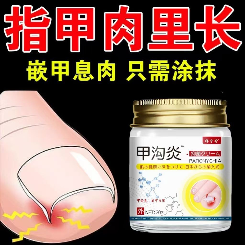 Paronychia Ointment Tie Meat Paronychia Infection บวมสีแดง Pseudo-Pseudo-Pseu