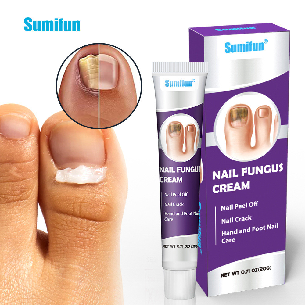 Sumifun English ครีมเล็บรัสเซีย 20g Cross-Border Onychomycosis ครีมกําจัดเล็บแบบนุ่ม K101919.9