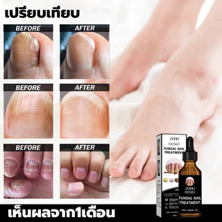 ห็นผลภายใน7วัน เอ็สเซ้นซ่อมแซมเล็บเสีย รักษารคเชื้อราที่เล็บ เล็บพัง เล็บขบ เซรั่มบำรุงเล็บ น้ำมันบำรุงเล็บ ดูแลเล็บ