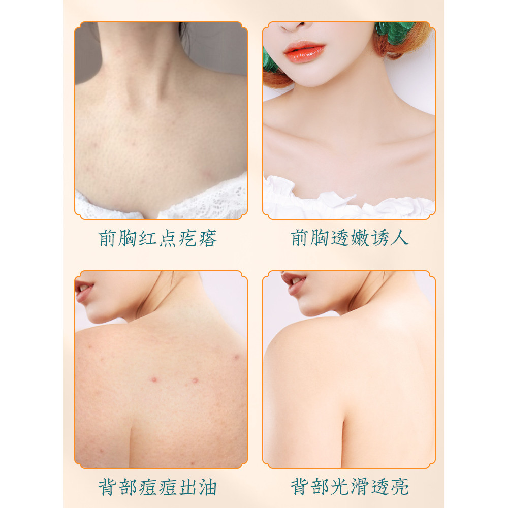 Li Jiaqi Back Acne Removal Beautify Back Spray กําจัดไรเต้านมด้านหน้ากลับลบสิวสิวยาวลบไก่ผิวเครื่องม
