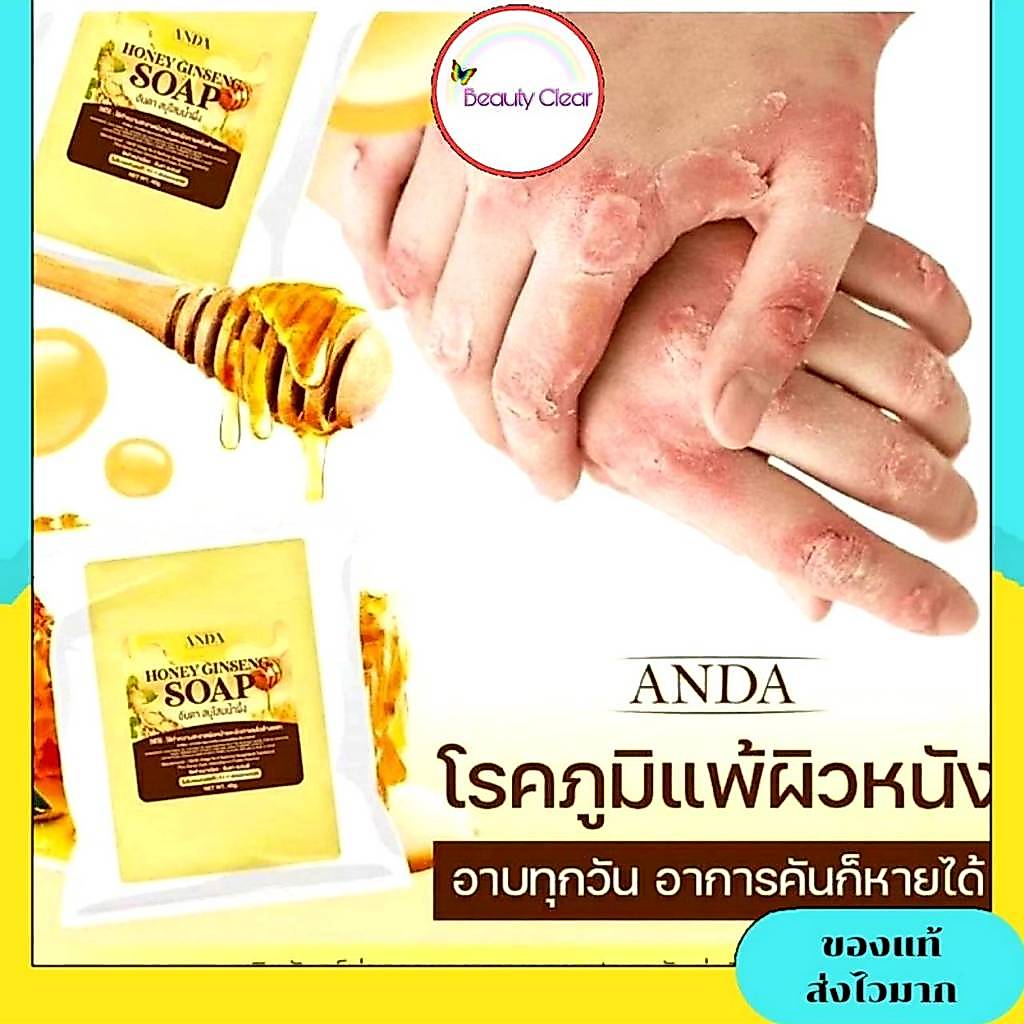 สบู่โสมน้ำผึ้ง จบปัญหาโรคผิวหนัง กลาก เกลื้อน เชื้อรา สะเก็ดเงิน