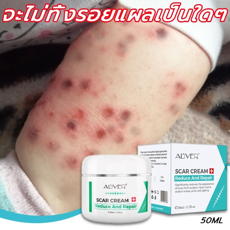 【ซื้อ 2 แถม 1】ALIVER ครีมลดรอยแผลเป็น 50ml ครีมทาแผลเป็น แผลไฟไหม้ รอยสิว รอยแตกลาย รอยแผลเป็นเป็นต้น ซ่อมแซมผิวหนัง ช่วยให้แผลเป็นหาย