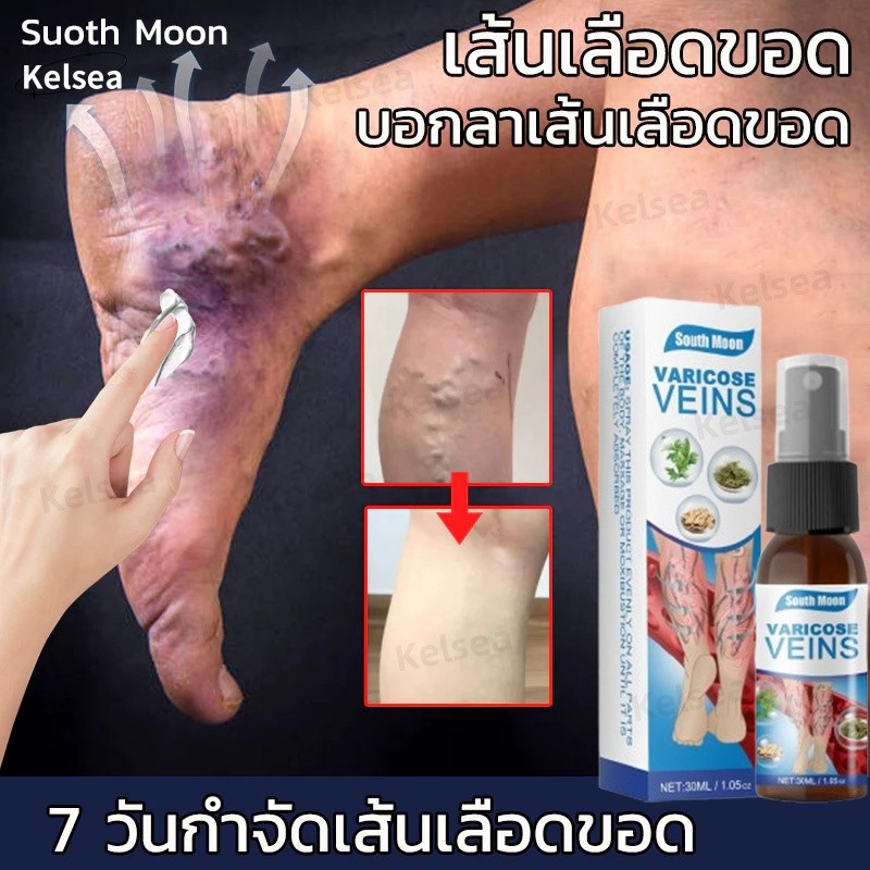 🦵South Moon🦵 สเปรย์ฉีดเส้นเลือดขอด เส้นเลือดขอด 30ml บรรเทาอาการบวมของเส้นเลือดบอกลาเส้นเลือดขอดเส้นเลือดดำอุดตันและอากา