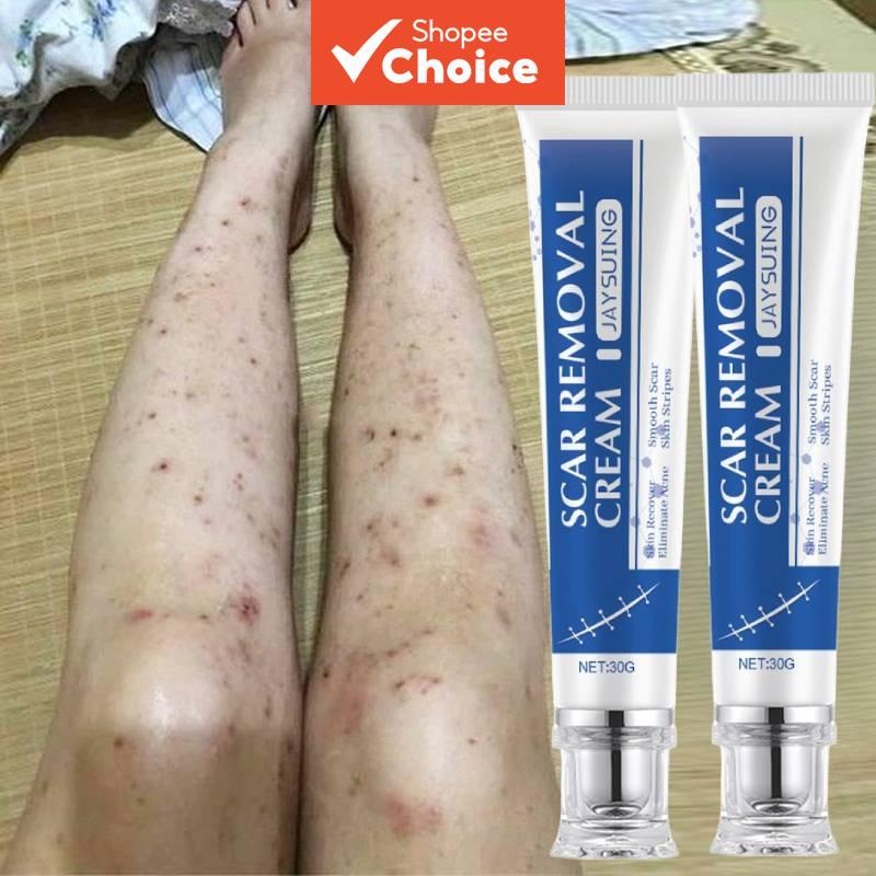 ครีมลดรอยแผลเป็นสําหรับขาและผิวแตกลาย 30 กรัม – ฟื้นบํารุงผิวที่มีรอยแผลเป็น เพิ่มความยืดหยุ่น กระชับผิว และให้ความชุ่มชื้น