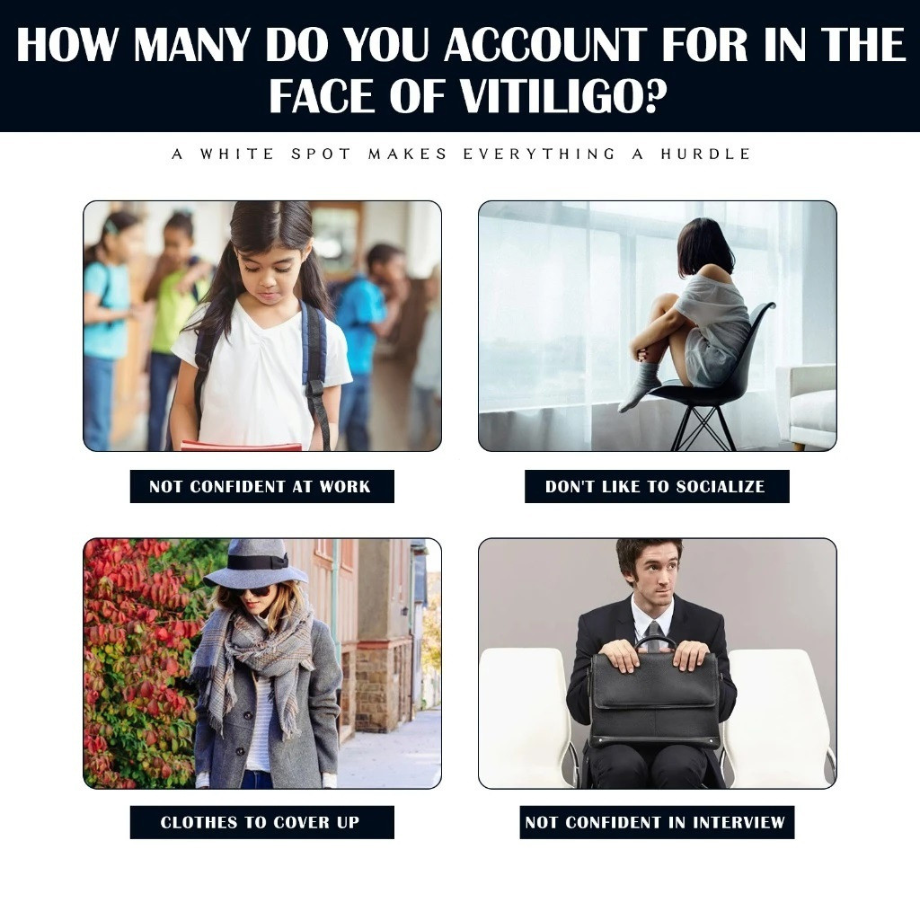 30ml {จัดส่งทันที} ครีมรักษา vitiligo ครีม vitiligo ครีม vitiligo น้ํายาล้าง กลายเป็นด่างขาว**-& - รูปที่ 6