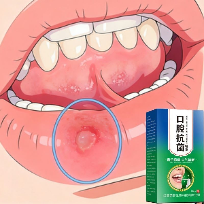 Oral Ulcer Powder ที่มีประสิทธิภาพ Anti-Inflamtion ทุ่มเทสําหรับ Bad Mouth Foaming Fire Tongue ดิบ U