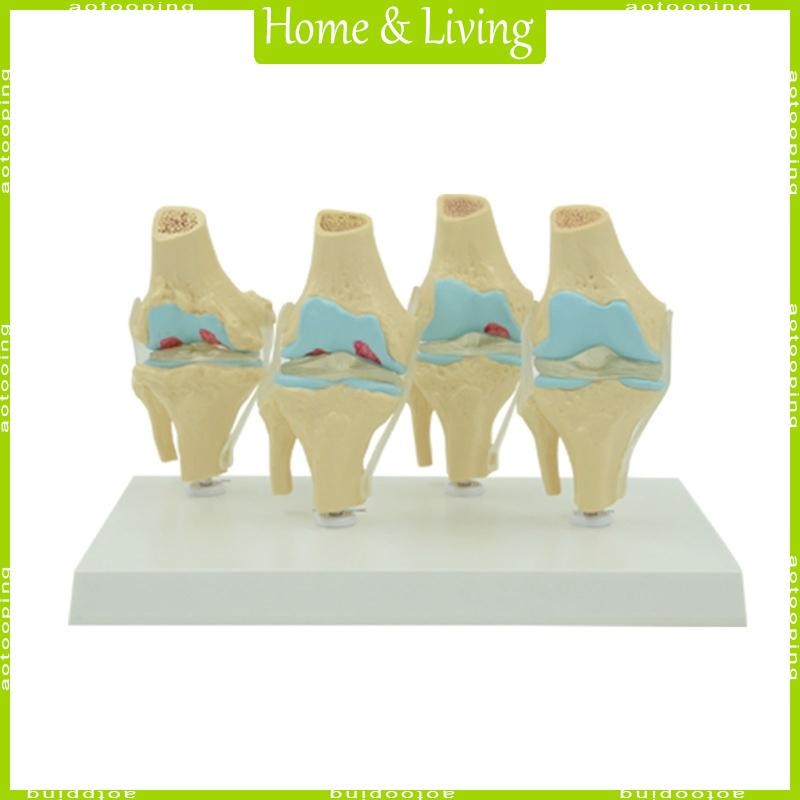 AOTOO ยืดหยุ่น Human Knee Joint Anatomy รุ่น Comparison of Knee Joint รุ่น Life Size