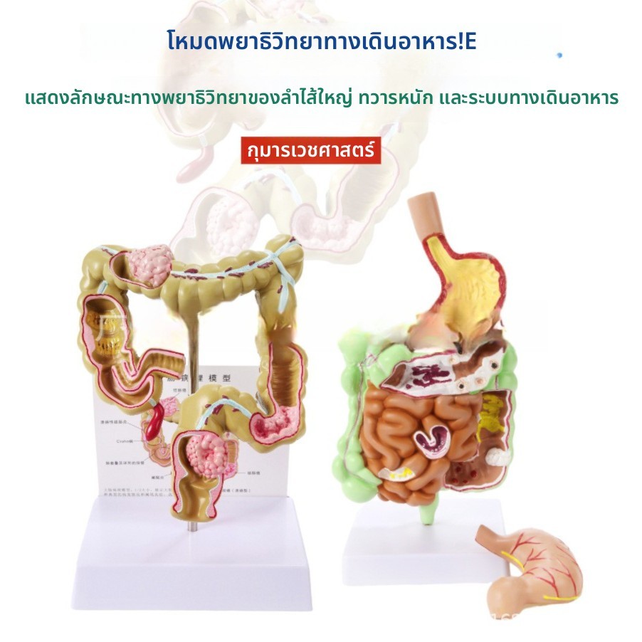 ชุดรูปแบบพยาธิวิทยาในระบบทางเดินอาหาร, ลําไส้ใหญ่โรคกายวิภาคศาสตร์รุ่น, เครื่องมือการสอนระบบย่อยอาหารสําหรับระบบทางเดินอาหารการศึกษาทางกา