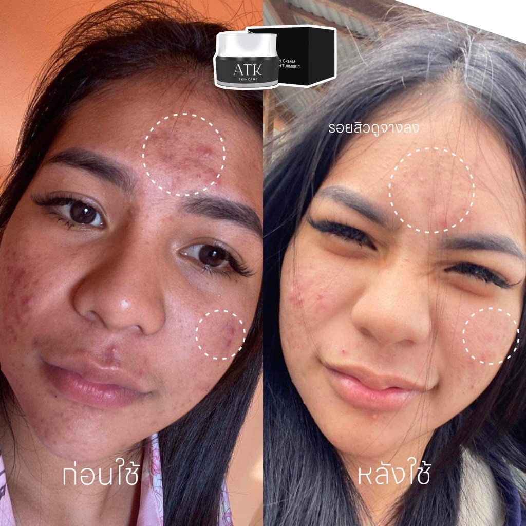 ATK Skincare Pearl Cream With Turmeric ครีมโยเกิร์ตไข่มุก atk ครีมลดรอย หน้าใส ลดสิว -- 10 g. --✿