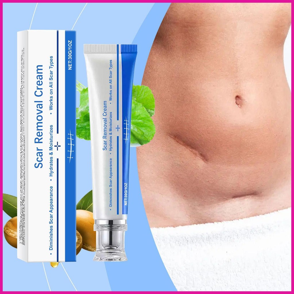 รอยแผลเป็นกําจัด Fade Stretch Marks 30g เจลอ่อนโยนสําหรับแผล Burn Keloid ผ่าตัด C-ส่วนการบาดเจ็บ Fac