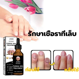 ห็นผลภายใน7วัน เอ็สเซ้นซ่อมแซมเล็บเสีย รักษารคเชื้อราที่เล็บ เล็บพัง เล็บขบ เซรั่มบำรุงเล็บ น้ำมันบำรุงเล็บ ดูแลเล็บ