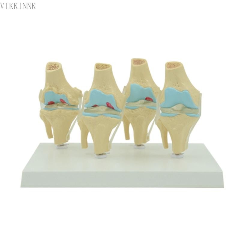 VIKK Life Size Human Degeneration Knee Joint Dise Model Anatomy ทางการแพทย์พร้อมฐาน