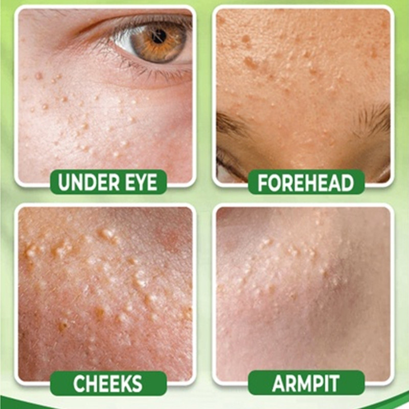 20g ไขมัน Granule ครีมวิตามินอี Krim Milia Seed Remover Eye ครีมไขมัน Granule Syringoma Milia Remover จาระบีธัญพืช Eye Health Care - รูปที่ 4