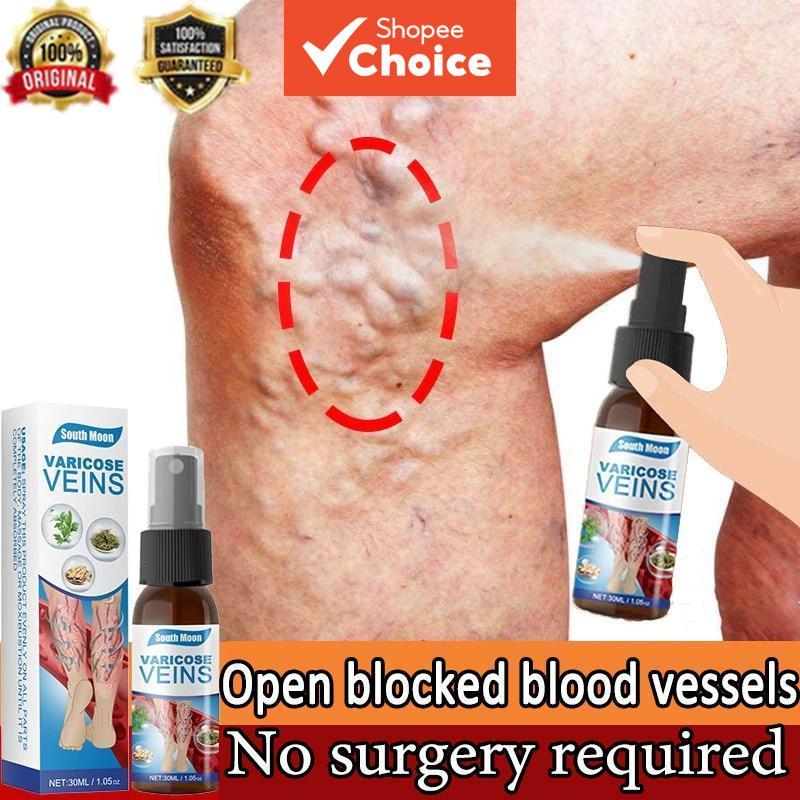 Varicose Vein Care Spray 30ml สูตรสมุนไพรสําหรับขา Professional Soothing Relief
