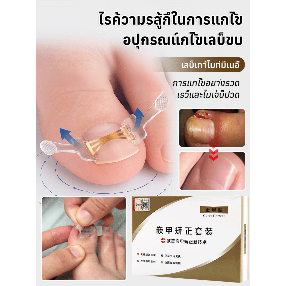 ⚡จัดส่งภายใน 24 ชม⚡ชุดแก้ไขเล็บขบ แผ่นแปะเล็บขบ /เล็บฝังลึกนิ้วเท้า ป้องกันเล็บขบเนื้อ บรรเทาอาการปวด /ซ่อมเล็บขบ งัดเล็บ เล็บฝังลึก สุขภาพเล็บ /แก้ไขเล็บเท้าผิดรูป ลดอาการบาดเจ็บ /การแก้ไขแบบไม่เจ็บปวด ﻿