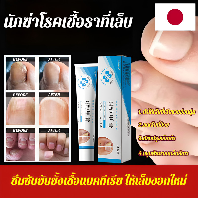 1/2/4ชิ้น buy 1 free 1/buy 2 free 2 ป้องกันการ เกิดซ้ําสีเทายาทาเล็บ ครีมรักษาโรคเชื้อราที่เล็บ ครีมดูแลเท้า ยารักษาเล็บ