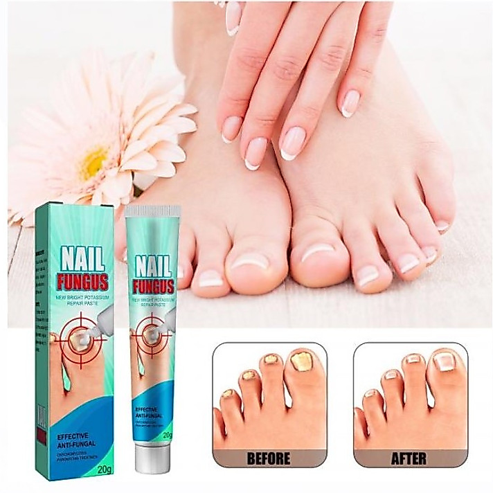 Nail fungus repair paste ครีมทาบำรุงและกำจัดเชื้อราที่เล็บช่วยฟื้นฟูเล็บ