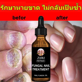ห็นผลภายใน7วัน เอ็สเซ้นซ่อมแซมเล็บเสีย รักษารคเชื้อราที่เล็บ เล็บพัง เล็บขบ เซรั่มบำรุงเล็บ น้ำมันบำรุงเล็บ ดูแลเล็บ