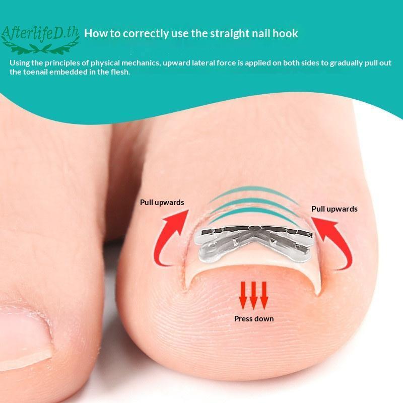 AF 2 ชิ้นคุด Toenail Corrector Pedicure กู้คืน Embed Toe Nail Treatment Professional คุด Toenail Cor