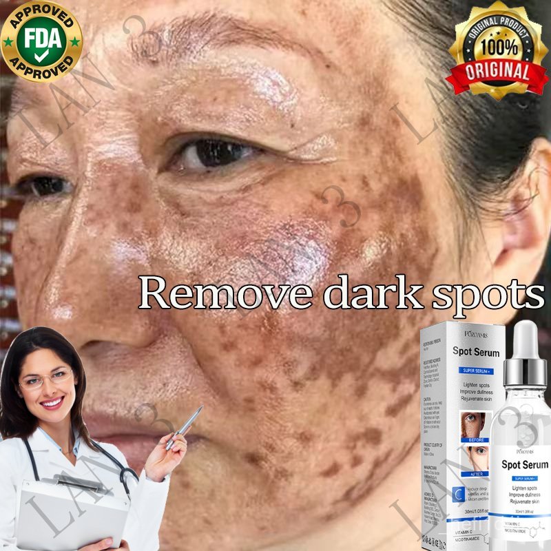 Freckle removal serum Remove chloasma and freckles Effectively remove age spots Remove age spotsanti